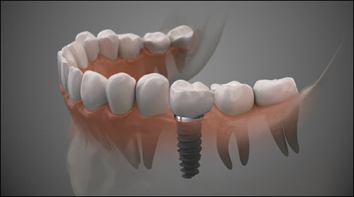 Advances Dental Implant Technology