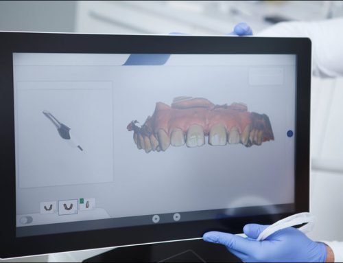 Custom Dental Implant Abutments: Revolutionized by 3D Scanners and CAD/CAM Files