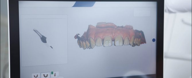 CAD CAM Abutments