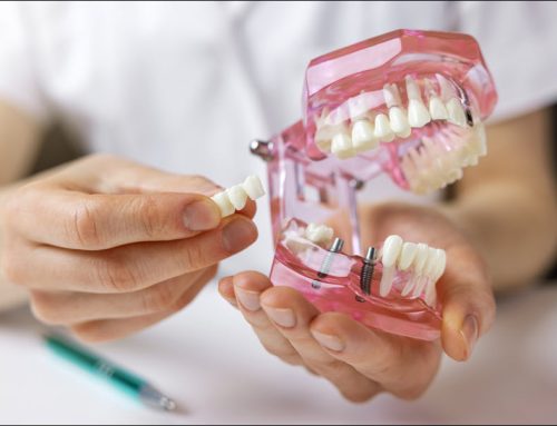 Understanding a Dental Implant System and Why ISOIMPLANT™ Certified Implants Stand Out